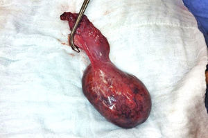 Surgical specimen with gallbladder.