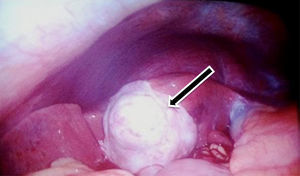 Neoformation at the expense of the complete gallbladder, white, uneven surface, firm, grainy.