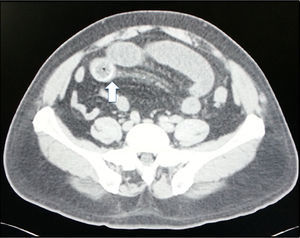 Oral contrast abdominal computed tomography, axial plane. The white arrow indicates a rounded image of a stone impacted in the terminal ileum.