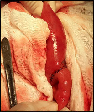 Intraoperative photography showing transverse enterorrhaphy on 2 planes at the level of the terminal ileum.