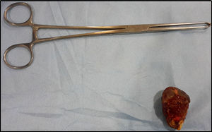 Photograph of surgical piece, showing the stone, and Allis clamp for reference.