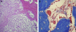 Histological staining with haematoxylin and eosin, and Massson's trichrome staining for group A. A non organised repair tissue is observed with fibrous features, with a large quantity of osteoclasts and cartilaginous areas (HE 20×, TM 40×).