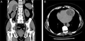 Computed axial tomography. (A) Adrenal hydatidosis. (B) Cardiac hydatidosis.