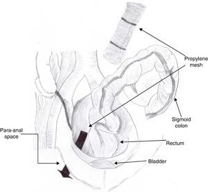 Diagram showing how the polyproplylene mesh was inserted into the right para-anal space, in the perineal plasty.