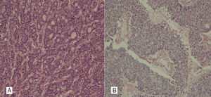 (A) Histological image with pseudoglandular pattern of hepatocarcinoma, with formation of glandular lumen. Positive Hepatocyte paraffin 1 (Hep-Par1), negative cytokeratins 7 and 20. (B) Non-differentiated cholangiocarcinoma, in which glandular lumen are distinguished and areas of intratumoral necrosis. AE1-AE3 and 7 cytokeratins tested positive; Hep-Par1 and cytokeratin 20 tested negative.