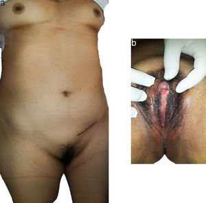Sexual development of the patient. (a) Mammary development is observed, gynecoid hair and the surgical scar from previous surgery in the left inguinal region. (b) External female genitals are observed.