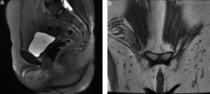 Magnetic resonance of the pelvis. Sequence enhanced in T2: (a) in sagittal plane; (b) in coronal plane, where the absence of the uterus and both ovaries is observed, and the presence of the right testicle within the ipsilateral inguinal canal is observed, together with the presence of corpora cavernosa and trace of genital tubercle.
