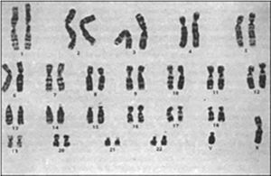 Karyotype of the patient, 46XY.