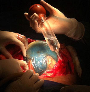 Insertion of vacuum assisted closure.