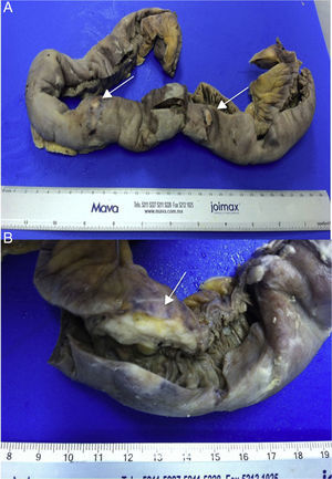 Segment of jejunum. (A) White, nodular lesions can be observed (arrows). (B) Close-up of one of the lesions with irregular edges and transmural extension (arrow).