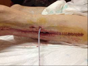 Surgical fasciotomy wound on the lower left limb with drainage tube.
