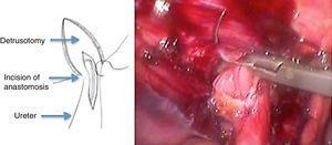 Anastomosis of the anterior circumference of the ureter open to the vesical mucosa.