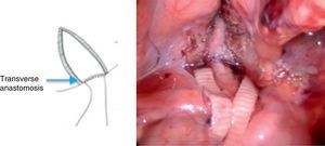 Completed transverse ureterovesical anastomosis.