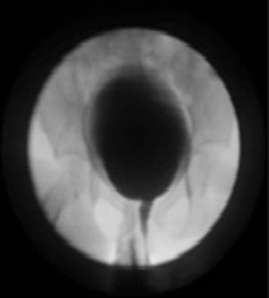 Cystoureterogram showing absence of post-operative reflux.