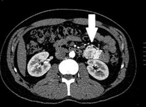 CT angiography: transversal slice showing hyper-uptake in mass with irregular well-defined borders dependent on the small bowel at the level of the proximal jejunum.
