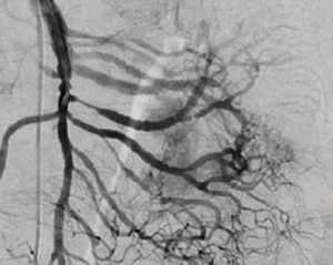 Post-embolisation arteriography showing 90% reduced vascularity of the lesion.