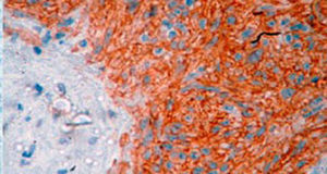Histopathological study of terminal ileum tumour showing immunohistochemical c-KIT positivity on (immunohistochemistry 10×).