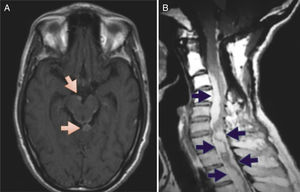 (A) Magnetic resonance of the skull, axial slice, T1 sequence with gadolinium, showing a nodular lesion (indicated by arrows) in the interpeduncular cistern and quadrigeminal cistern, with arachnoid enhancement around the midbrain. (B) Magnetic resonance of the cervical spine, sagittal slice, T1 sequence with gadolinium, showing perimedullary lesions (indicated with arrows) that enhance with contrast, irregular and generating compression of the ventral and dorsal face of the cord.
