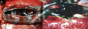 Trans-operative image. (A) Showing tense duramater of the spinal canal, under pressure, with haemorrhagic intradural lesion, black in colour. (B) Showing a black intradural lesion, surrounding the nerve roots of the spinal canal.