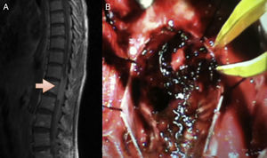 (A) Magnetic resonance imaging of the thoracolumbar spine, sagittal slice, T1 sequence, showing an iso-intense, intradural lesion, compressing the spinal canal. (B) Trans-operative image with blackish lesion with no arachnoid infiltration, with nerve routes observed below the arachnoid plane.
