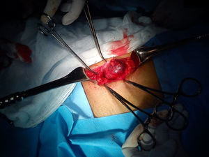 Perioperatively, a cyst is observed in situ in the dissected inguinal region.