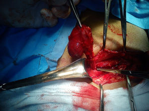 Perioperatively, the cyst is tensed/pulled and we observe the projection of the round ligament from the deep inguinal orifice (shown with the clamp).