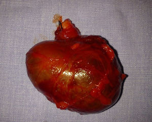 The complete surgical specimen is observed, the round ligament cyst, and the sectioned round ligament.