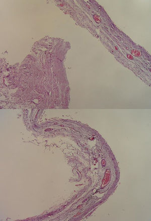 Panoramic view of the cystic lesion, with presence of blood vessels and with smooth muscle in the wall.