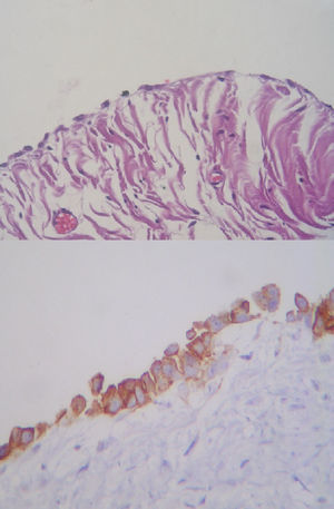 Top: panoramic view of HE 40× the coating of the cystic wall, where a cubic type and simple flat mesothelilal epithelium may be observed. Bottom: calretin stain which is expressed in mesothelial cells (immunohistochemistry).