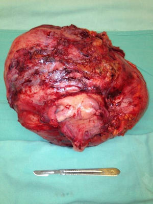 Product of the surgical resection.