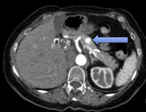 Axial slice of computed tomography of the abdomen without intravenous contrast in arterial phase. A hypervascular lesion of 11mm diameter is observed in the body of the pancreas, which quickly presents contrast lavage.