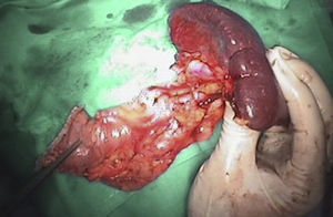 Photo. Part of the anterior part of the surgical specimen is shown, in which the tumour site may be observed.