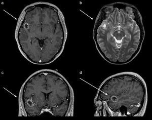 Magnetic resonance of the skull. (a) Axial section contrast enhanced T1 sequences which shows tumour with a hypointense centre and enhancement of the contrast in the shape of a ring. (b) Axial section in T2 sequence which shows a hypointense ring and with a hyperintense centre, with no perilesional swelling. (c) Coronal section contrast enhanced in T1 sequence which shows the location in the first right temporal gyrus.