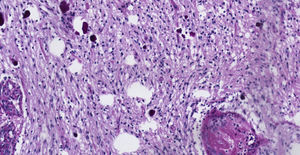 Pilocytic astrocytoma. Pilocytic areas consisting of bipolar fusiform cells, and some Rosenthal fibres and calcifications (10× enlargement, haematoxylin and eosin stain).