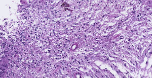 Pilocytic astrocytoma. Spongiotic areas consisting of multipolar cells and associated microcysts. (10×, enlargement, haematoxylin and eosin stain).