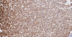 Pilocytic astrocytoma. Immunoreactivity for glial fibrillary acidic protein (GFAP) is very intense in the prolongation of the neoplastic cells (10× enlargement. Immunohistochemistry).