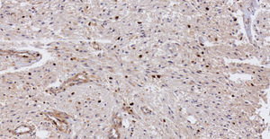 Pilocytic astrocytoma. The rate of cellular proliferation measured with Ki-67 is low (3%) (10× enlargement, immunohistochemistry).