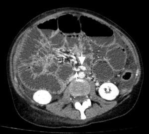 Intravenous contrast enhanced computed tomography axial imaging of the abdomen. Inversion of the mesenteric vessels, with superior mesenteric artery (thin arrow) located to the right of the superior mesenteric vein (thick arrow).