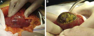 (A, B) Location of the stone. Colotomy for extracting the stone.
