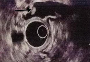 Hyper-echogenic 10mm lesion on its surface, which does not project a posterior acoustic shadow, which may correspond to a vesicular polyp vs. biliary sludge (arrow).