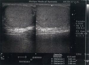 Doppler ultrasound of the left testicle with no evidence of flow and an absence of saturation of the vascular structures.