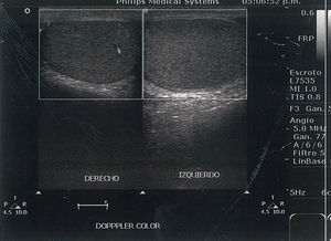 Doppler ultrasound which compares the vascular flow in both testicles.