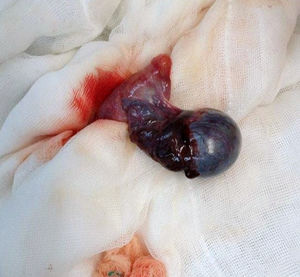 Testicle with haemorrhagic necrosis with 360° torsion.