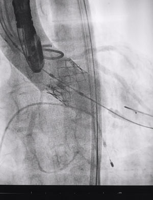 Angiographic control to confirm the correct positioning of the implant and determine the presence or absence of paravalvular leakage. This is also reviewed by echocardiogram.