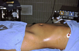 Abdomen distended due to right-sided paraovarian cyst.