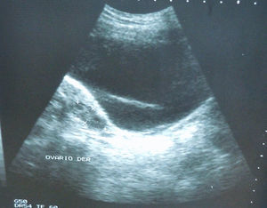 Paraovarian cyst with septum.