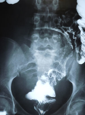 Displaced sigmoid colon.