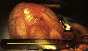 Upper part of the paraovarian cyst.