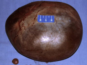Paraovarian and hydatid cyst of Morgagni.