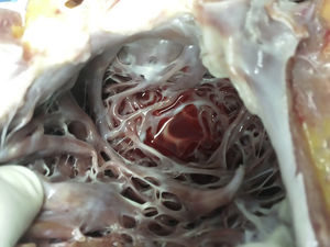 Section of the left ventricle showing hypertrabeculation of the left ventricle.